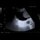Venous congestion of liver: US - Ultrasound